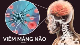 Viêm màng não tăng bạch cầu ái toan là gì?