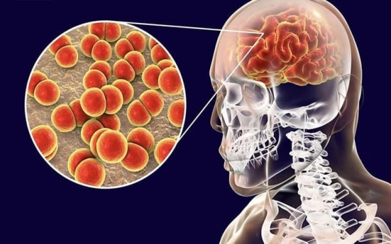 viêm màng não tự miễn là gì