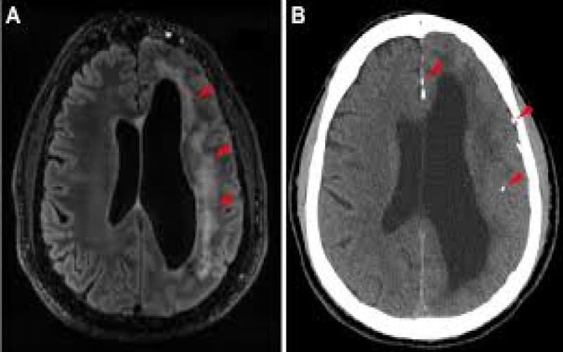 viêm màng não tự miễn là gì