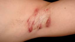 Viêm tuyến mồ hôi mủ là gì? Nguyên nhân, điều trị