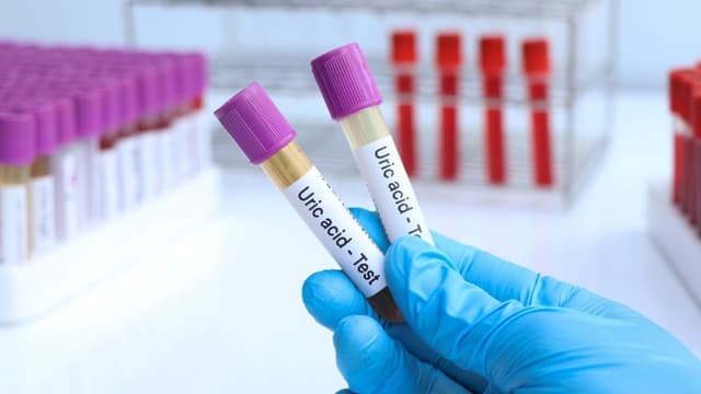 Xét nghiệm axit uric có phải nhịn ăn không? Lưu ý trước khi đi xét nghiệm