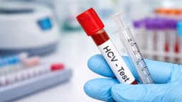 Cách đọc kết quả định lượng virus viêm gan C