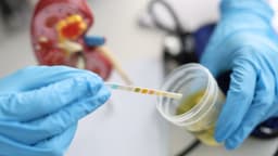 Xét nghiệm nước tiểu có ra suy thận không?