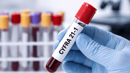 Các xét nghiệm tầm soát ung thư phổi