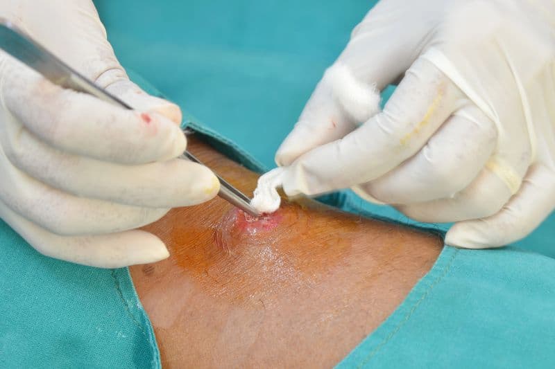 áp xe mụn nhọt ở mông