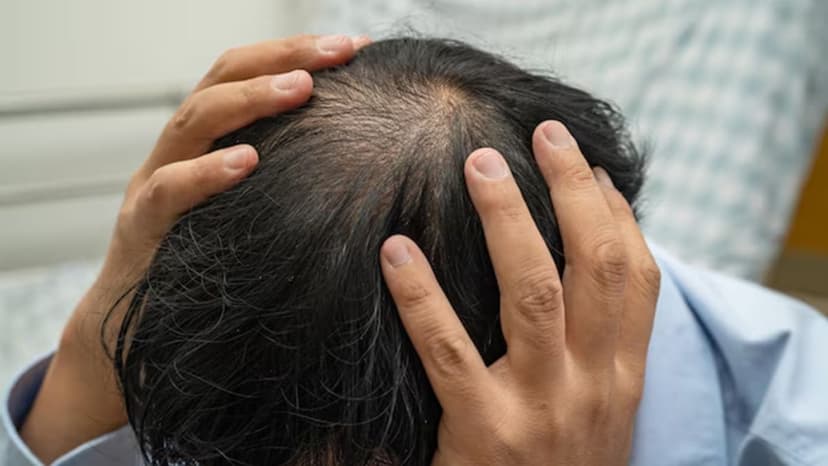 Cắt u da đầu đường kính dưới 5cm: Khi nào cần và quy trình thực hiện