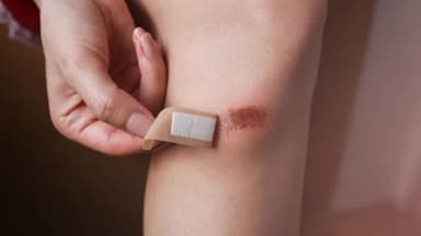 Người bị rách da nên làm gì? Hướng dẫn đầy đủ từ A đến Z