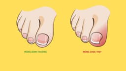 Vì sao bị móng chọc thịt sau sinh?