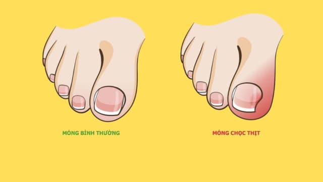 Vì sao bị móng chọc thịt sau sinh?