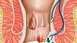 Có cần cắt da thừa hậu môn sau cắt trĩ không?