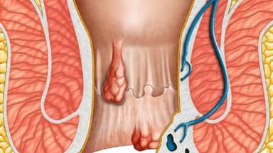 Có cần cắt da thừa hậu môn sau cắt trĩ không?