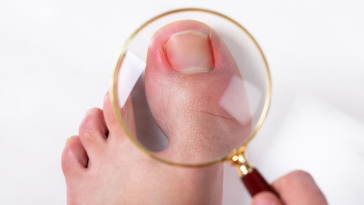 Cảnh báo dấu hiệu móng chân mọc ngược: Nhận biết sớm để tránh biến chứng