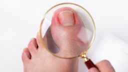 Cảnh báo dấu hiệu móng chân mọc ngược: Nhận biết sớm để tránh biến chứng