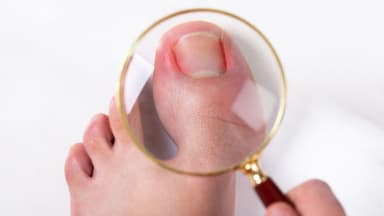 Cảnh báo dấu hiệu móng chân mọc ngược: Nhận biết sớm để tránh biến chứng