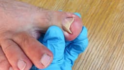 Phẫu thuật móng chọc thịt thế nào? Ở đâu?