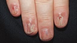 Phẫu thuật u cuộn mạch dưới móng thế nào? Hướng dẫn đầy đủ từ A-Z