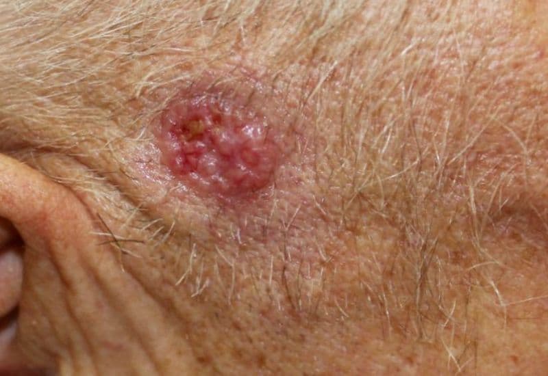 cắt u da đầu lành đường kính dưới 5 cm