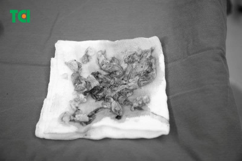 Hình ảnh u nang buồng trứng của chị H. (Ảnh: TCI)