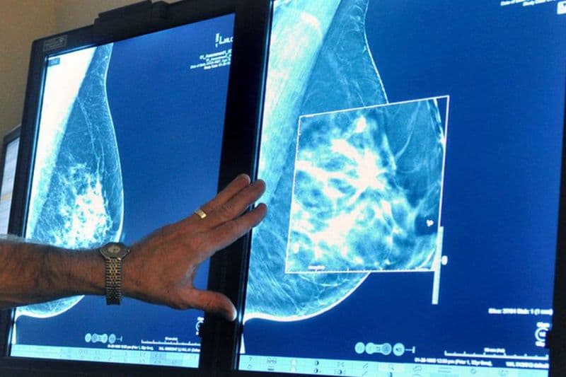 chỉ định chụp x quang tuyến vú