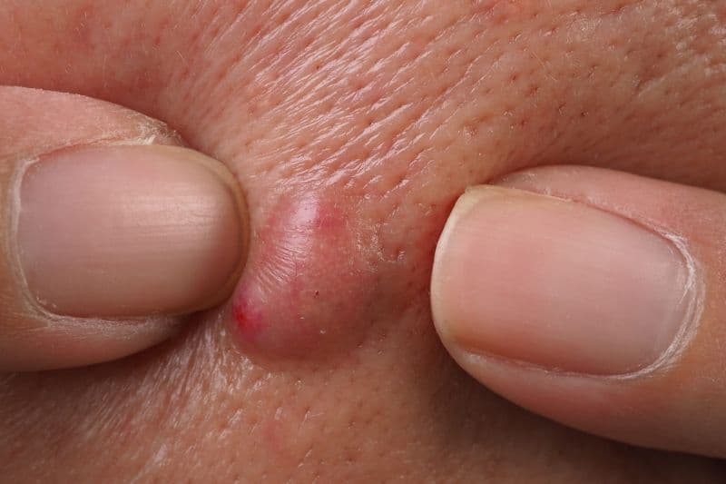 làm sao để hết áp xe