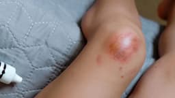 Áp xe đầu gối: Nguyên nhân, dấu hiệu, cách điều trị