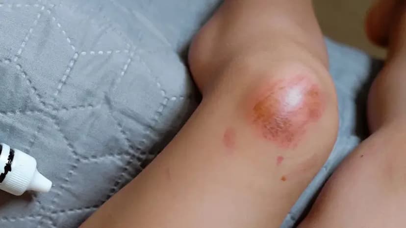 Áp xe đầu gối: Nguyên nhân, dấu hiệu, cách điều trị