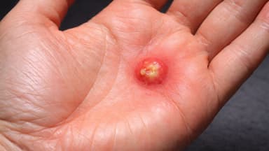 Mụn mủ, áp xe lòng bàn tay có nguy hiểm?