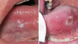 Hình ảnh áp xe lưỡi – có nguy hiểm không?