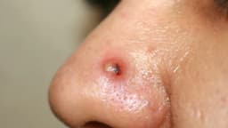 Áp xe mũi có mủ có nguy hiểm không?