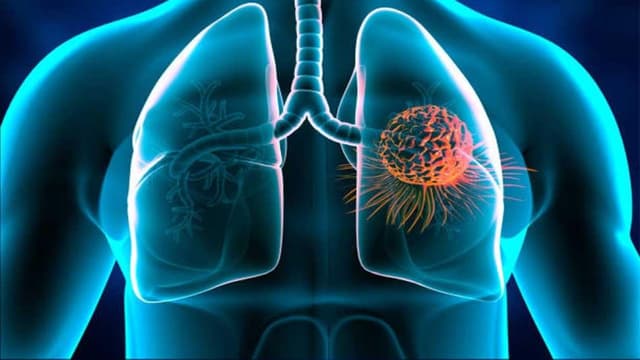 Các thuốc kháng sinh điều trị áp xe phổi