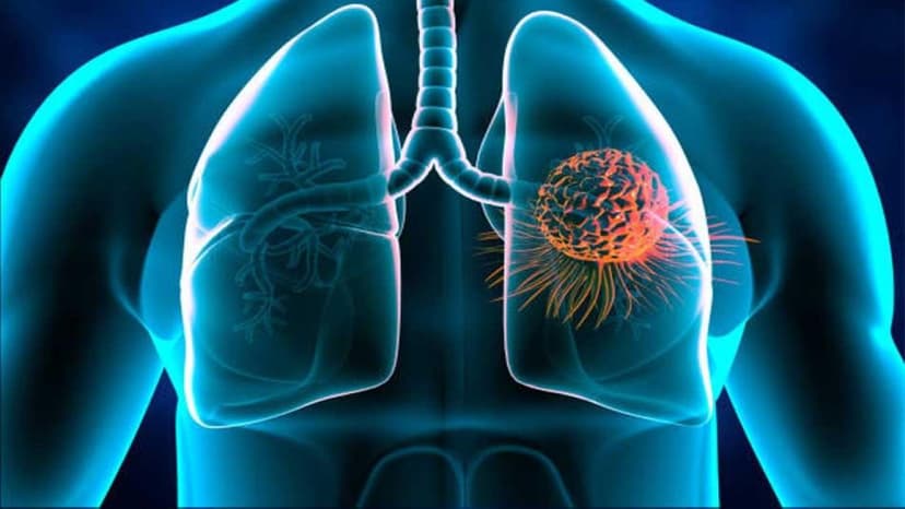 Các thuốc kháng sinh điều trị áp xe phổi