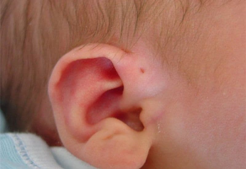 áp xe rò luân nhĩ là gì