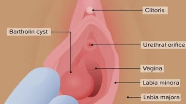 Áp xe viêm tuyến bartholin có tự khỏi? Khi nào cần chích rạch?
