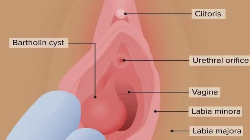 Áp xe viêm tuyến bartholin có tự khỏi? Khi nào cần chích rạch?