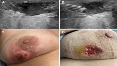 Vì sao áp xe vú bị cắt tứ chi?