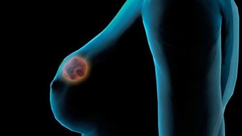 áp xe vú có bị ung thư không