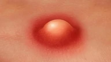 Áp xe vùng kín có nguy hiểm không? Dấu hiệu áp xe vùng kín