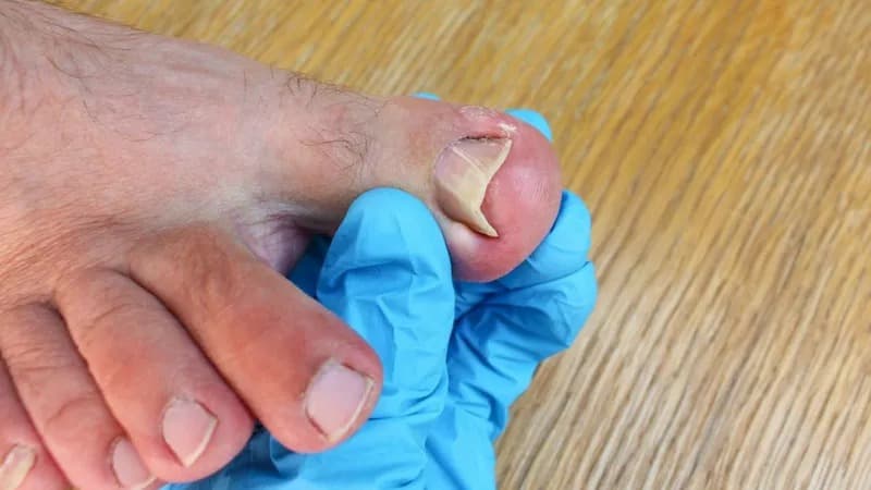 móng chân mọc ngược