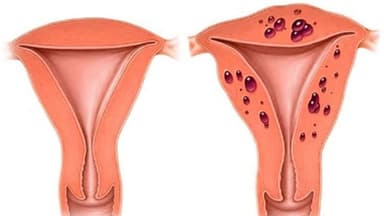 Bệnh cơ tuyến tử cung có nguy hiểm không
