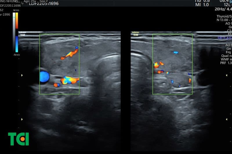 siêu âm tuyến giáp 4d