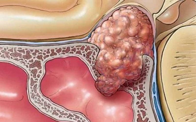 u lành tuyến yên