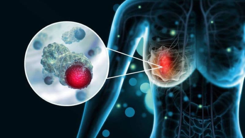 ung thư biểu mô tuyến vú xâm nhập độ 2