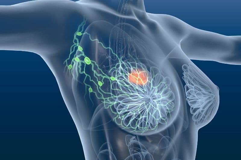 bệnh ung thư vú do đột biến gen