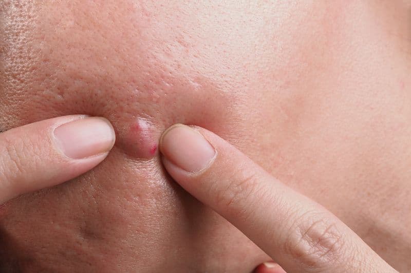 tự nặn mụn áp xe