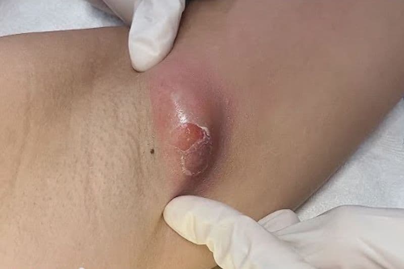 tự nặn mụn áp xe