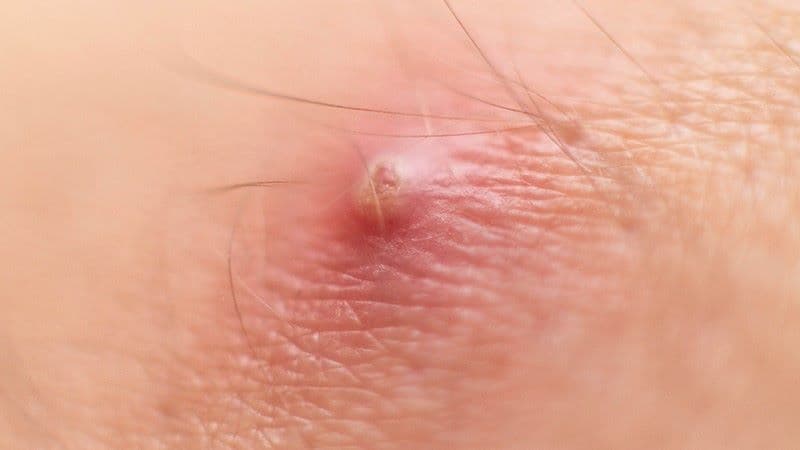 viêm rò xoang lông vùng cùng cụt