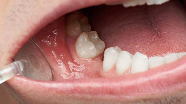 Bị mất răng hàm dưới có sao không?