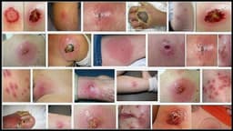 Hay bị mụn nhọt áp xe kiêng ăn gì cho nhanh khỏi?