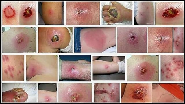 Hay bị mụn nhọt áp xe kiêng ăn gì cho nhanh khỏi?