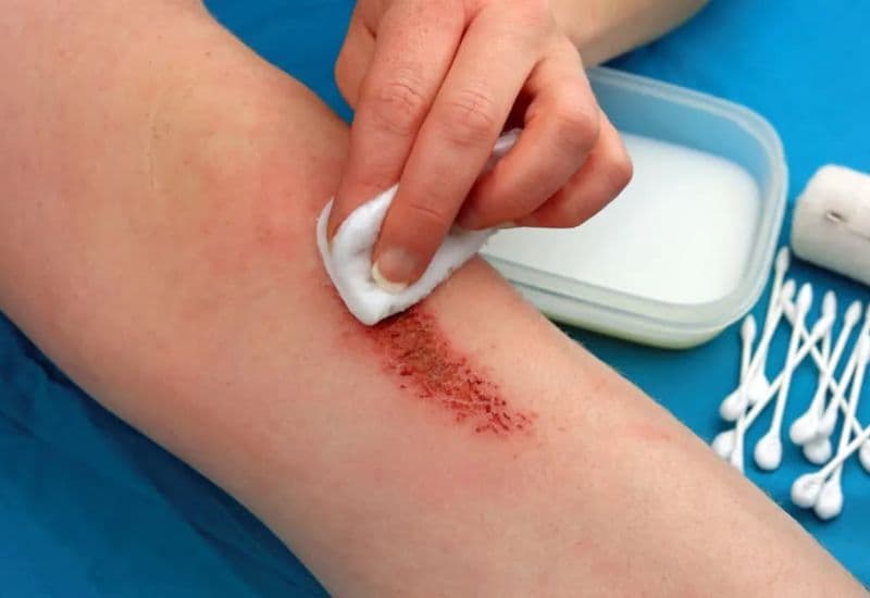 bị rách da nên làm gì